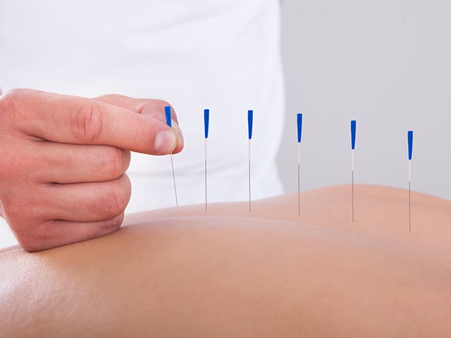 acupuntura2 ACUPUNTURA